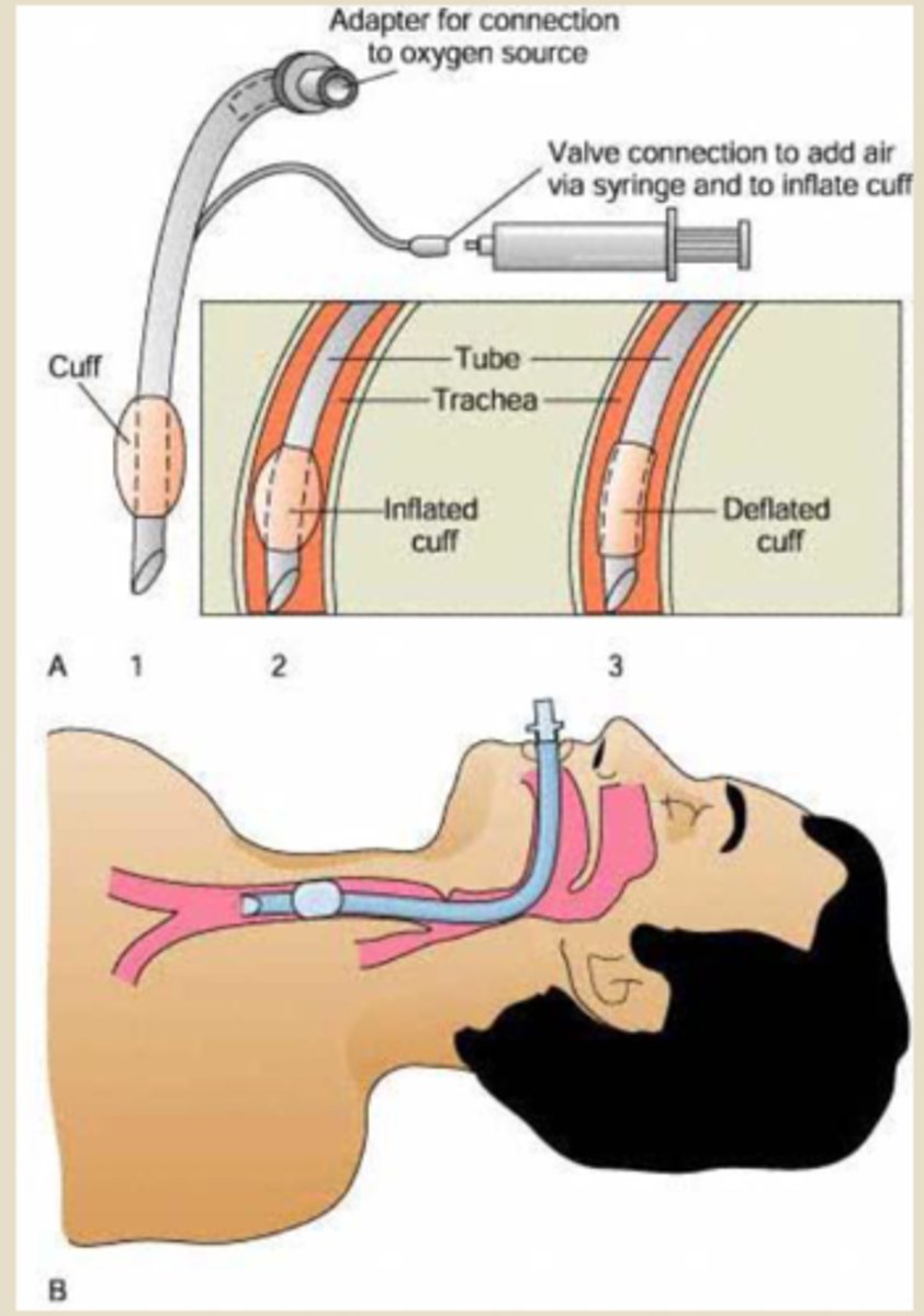 <p>we usually use 'these' for ER &amp; ICU situations. the tube goes into Trachea</p><p>- bigger tube: gives O2. airbags can attach</p><p>- smaller tube: can administer drugs (ex. epinephrine) here. only few drugs can be administered this way</p>