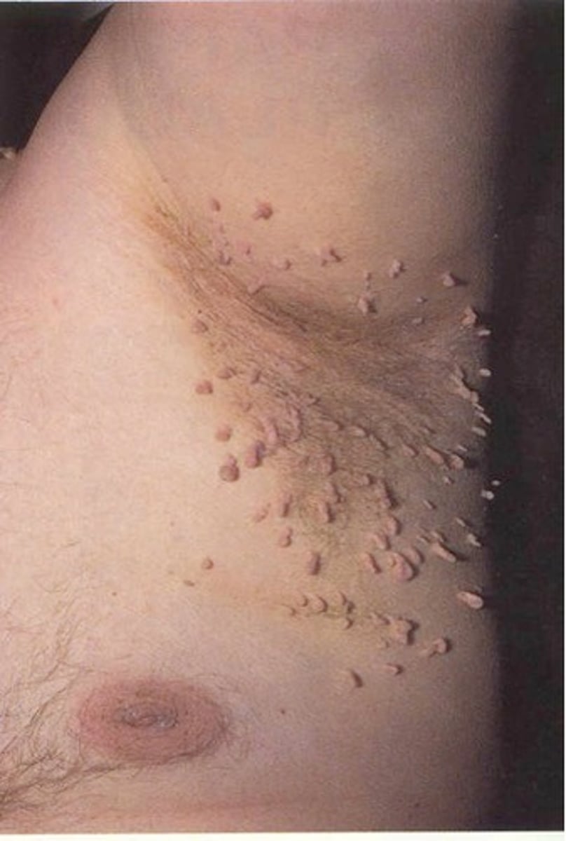 <p>small outgrowth or extension of skin that looks like a flap</p>