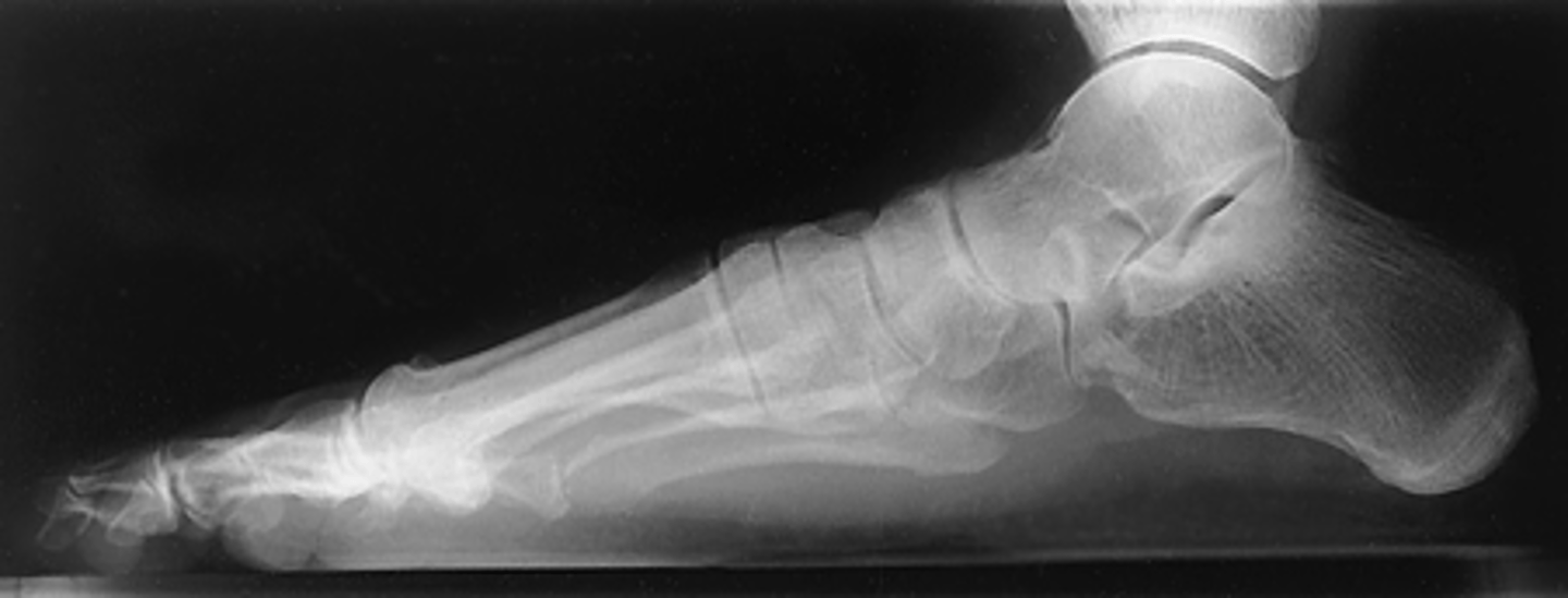 <p>- Horizontal beam</p><p>- Entire foot demonstrated</p><p>- Plantar surfaces of MTs superimposed</p><p>- Optimal exposure factors</p>