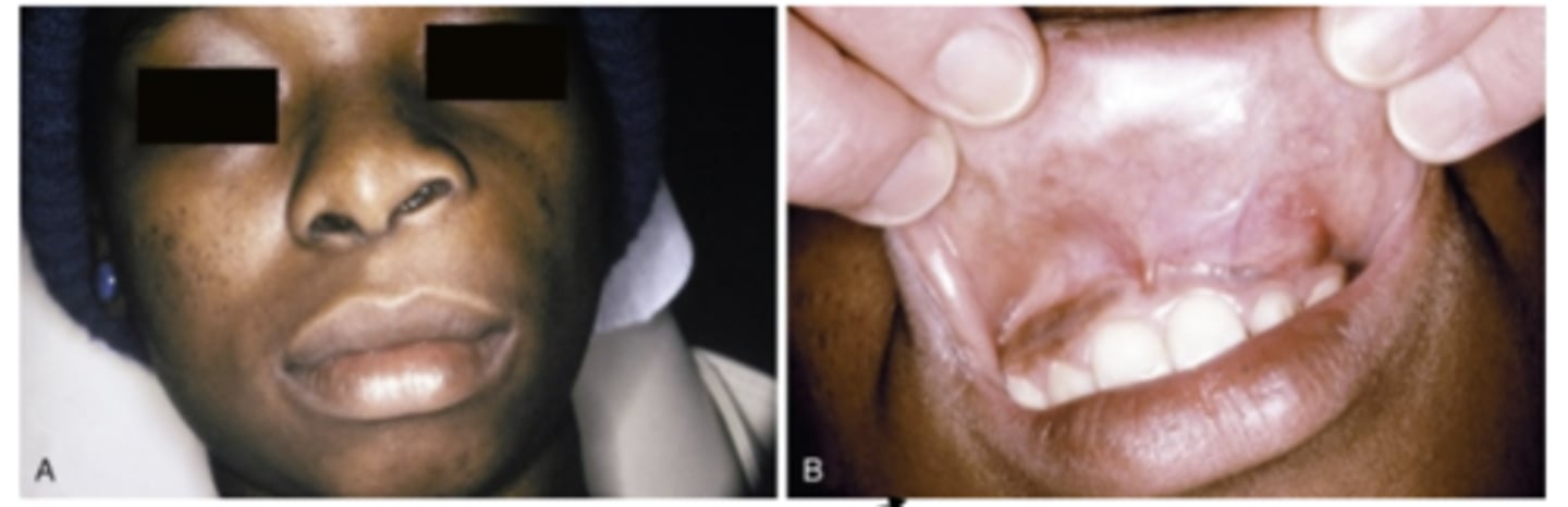 <p>What do Nasolabial cyst cause? where are they located? </p>