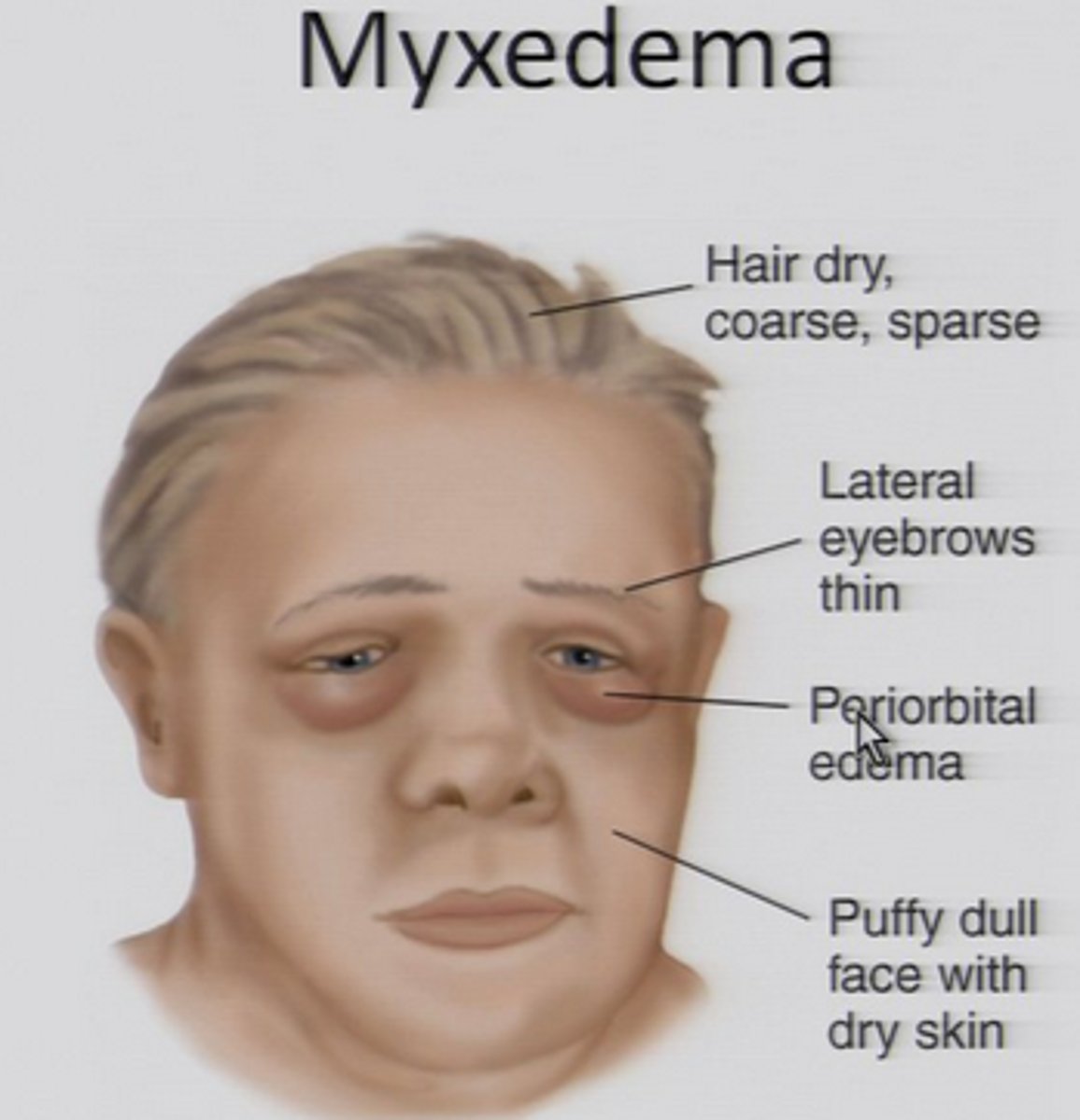 <p>Myxedema</p><p>(caused by hypothyroidism, Graves disease [pretibial])</p>