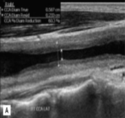 <p>This was seen at the patient’s aorta.&nbsp;</p><ol><li><p>How does it appear sonographically?</p></li><li><p>What pathology can be assumed here?</p></li></ol><p></p>