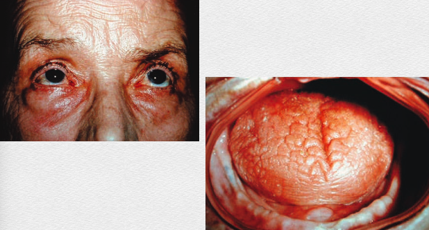 <p>an autoimmune disorder affecting <span style="color: red;">exocrine glands</span></p><p>specifically the <span style="color: red;">lacrimal </span>and<span style="color: red;"> salivary glands</span>, causing dry eyes and dry mouth</p>