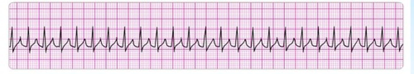 <p>p waves are hidden in T waves</p><p>rate: 150-250</p><p>regular waves (no variation)</p>