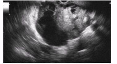 <ul><li><p><span style="background-color: transparent;">AKA cystadenocarcinoma</span></p></li><li><p><span style="background-color: transparent;">Larger cystic areas (> 2 cm)</span></p></li><li><p><span style="background-color: transparent;">Peripheral calcifications</span></p></li><li><p><span style="background-color: transparent;">Large, unilocular, encapsulated masses</span></p></li><li><p><span style="background-color: transparent;">Occurs mainly in tail</span></p></li><li><p><span style="background-color: transparent;">Has good prognosis for pancreatic malignancy</span></p></li></ul><p></p>