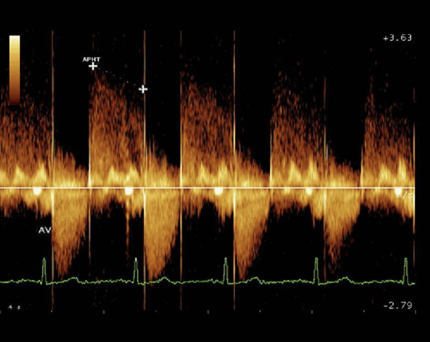 <p>What Doppler artifact is demonstrated on the image? </p>