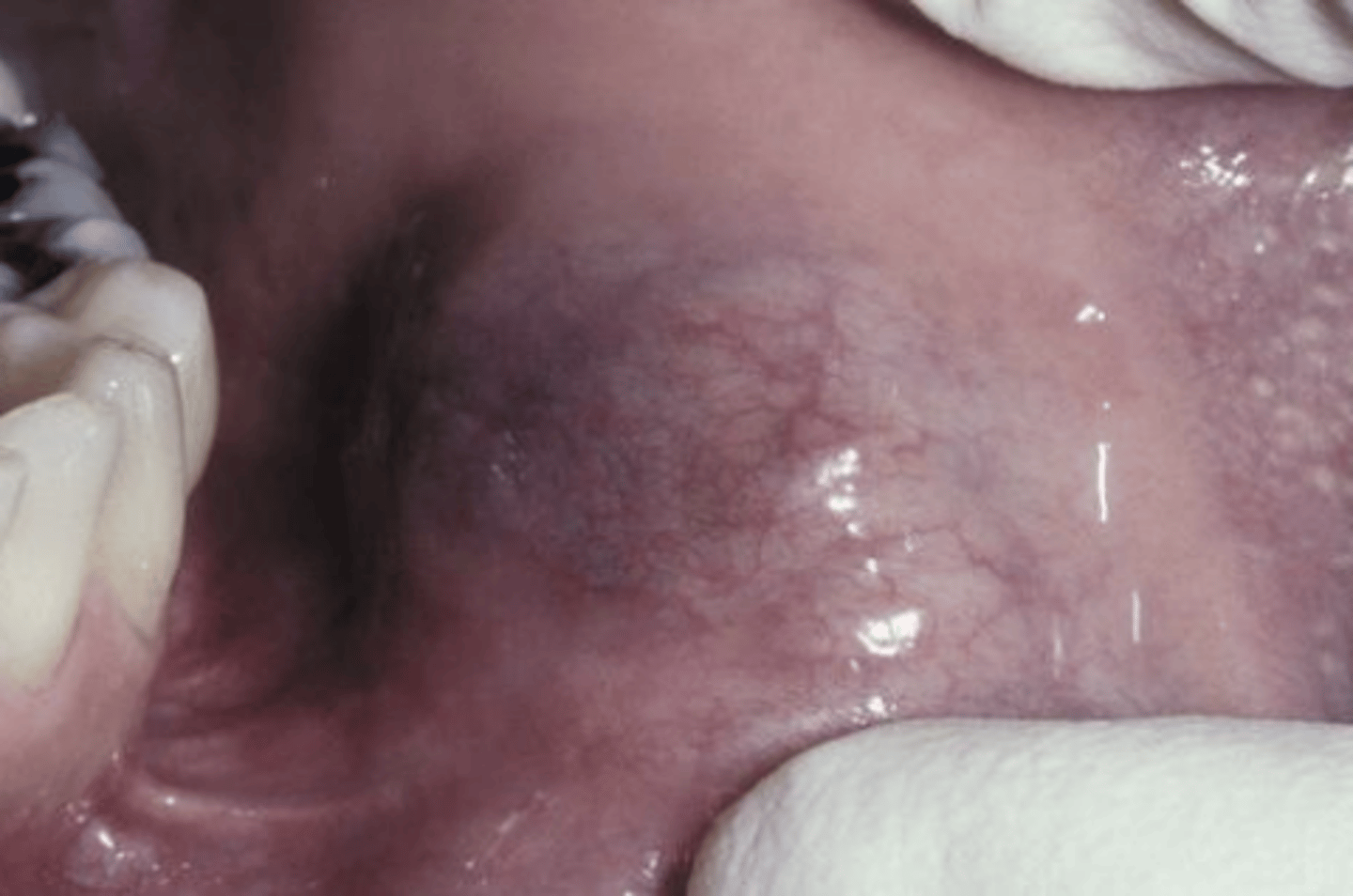 <p>Secretory Carcinoma</p>