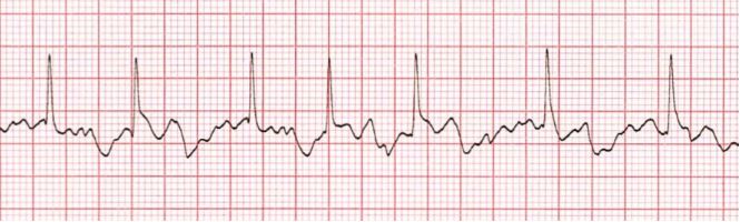 <ul><li><p>&nbsp;most common type of heart arryhthmia, and is a rapid, inefficient, quivering of the heart that is common in the elderly population.</p><ul><li><p>no p wave.</p></li><li><p>irregular and often rapid heart rhythm.</p></li></ul></li></ul><p></p>