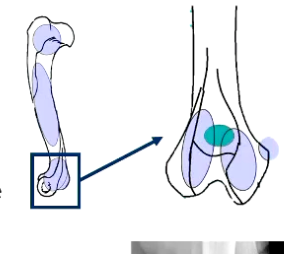 <p>Development:</p><p>• 5 Centres of ossification:</p><p>• Proximal epiphyses</p><p>• Body</p><p>• Condyle:</p><ul><li><p>Medial epicondyle</p></li><li><p>Medial half</p></li><li><p>Lateral half</p></li></ul><p></p>