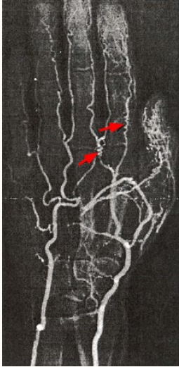 <p><strong>Thromboangiitis Obliterans Diagnosis</strong></p><p>-Typically ______ diagnosis using clinical criteria</p><p>-Labs obtained to rule out other disease process like scleroderma</p><p>-______: shows segmental vascular inflammation, confirms diagnosis </p><p>-Aortography: shows ________ collaterals</p>