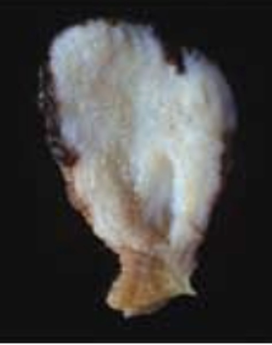 <p>What kind of tumor is this?</p>