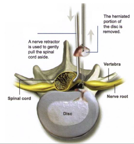 Rest, physical therapy, pain meds

Surgical - Discectomy/Microdiscectomy