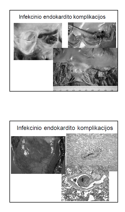 <p>miokardo abscesai - balti blotai</p><p>pusmėnilinio vožtuvo perforacija</p><p>sausgyslių siūlų ir vožtuvo atplyšimas nuo speninių raumenų</p>