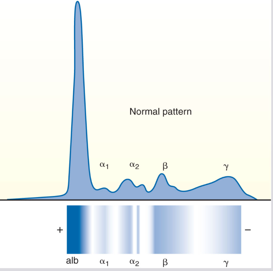 <p>gamma (γ) band with serum electrophoresis at pH 8.6</p>