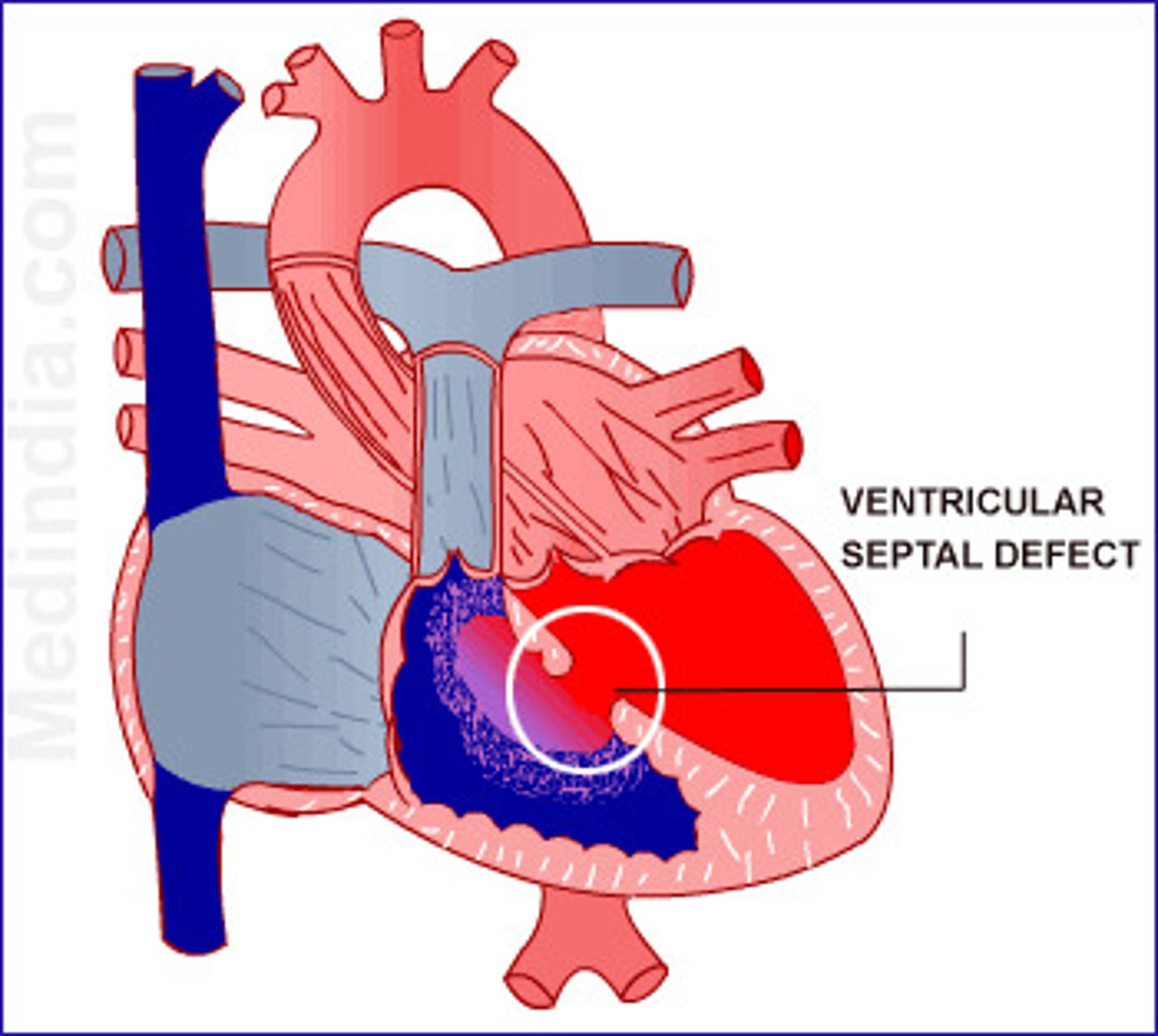 <p>- It occurs when there is an opening in the ventricular septum, or dividing wall between the 2 lower chambers of the heart known as the right and left ventricles.</p><p>- A VSD occurs when a portion of the ventricular septum does not completely close.</p><p>- VSDs may be single or multiple and are defined based on their anatomic location within the septum</p>