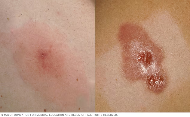 <ol><li><p>crowing </p></li><li><p>frequent skin to skin contact </p></li><li><p>compromised skin</p></li><li><p>contaminated items and surfaces </p></li><li><p>lack of cleanliness </p></li></ol><p></p>