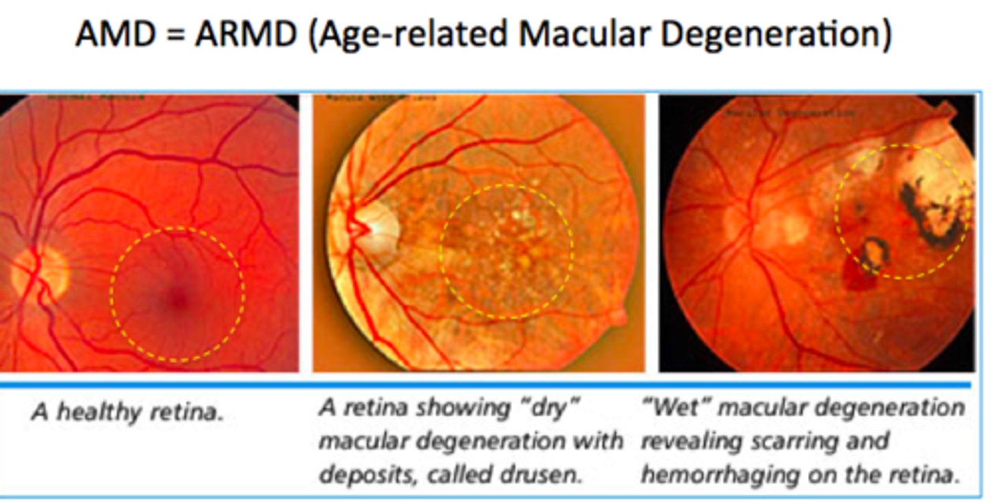 <p>1) Dry or non-neovascular or atrophic</p><p>2) Wet or neovascular or exudative</p>