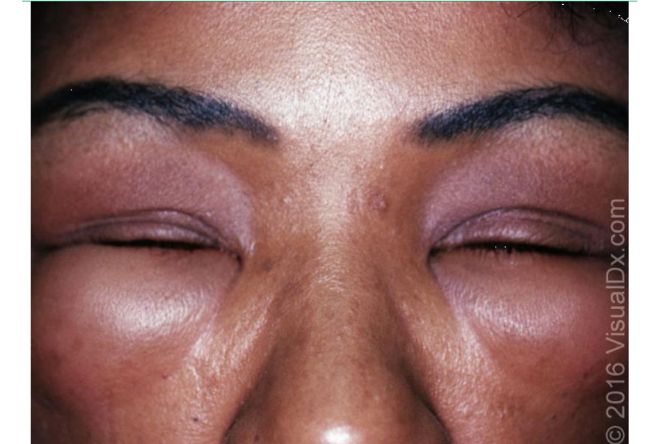 <ul><li><p>large edematous area ± pruritus </p></li><li><p>deep and ill defined areas</p></li><li><p>occurs w/in hrs and resolves w/in 1-3 days</p></li><li><p>pressure: delayed, painful, erythematous swelling induced by sustained pressure</p></li><li><p>vibratory: caused by vibrating stimulus</p></li></ul><p></p>