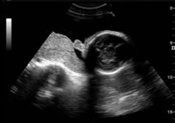 <p>a) frontal bossing</p><p>b) normal fetal profile</p><p>c) micrognathia</p><p>d) proboscis</p>
