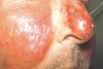 <p>Streptococcus pyogenes (GAS)</p>