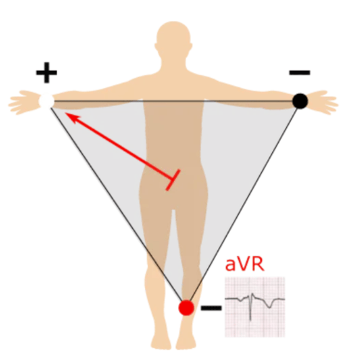 <p>Left half --> right arm; produces a negative waveform as heart's electrical activity naturally moves down &amp; to the left</p>