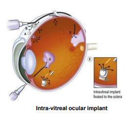 <p><strong>Ocular Implants</strong></p><ol><li><p>implants made from ______________ polymers which are _________, can result in drug release over ______ months period</p></li><li><p>mainly treat ______ segment eye disorders</p></li><li><p>__________ _______ delivers the drug over a 6 month period (manage <strong>Cytomegalovirus retinitis</strong>, a complication of ____)</p></li><li><p>use associated with _________ (<strong>inflammation</strong> of the intraocular fluids)</p></li></ol>