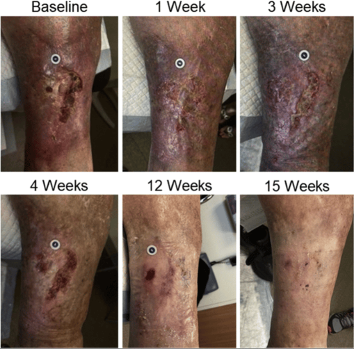 <p>Edema</p><p>Chronic pain</p><p>Skin changes</p><p>Heaviness of affected limb</p><p>Swelling</p><p>Venous Ulcers</p>