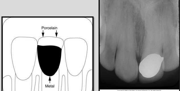 <ul><li><p>The metal component appears completely radiopaque</p></li><li><p>Porcelain components appears slightly radiopaque. </p></li></ul><p></p>