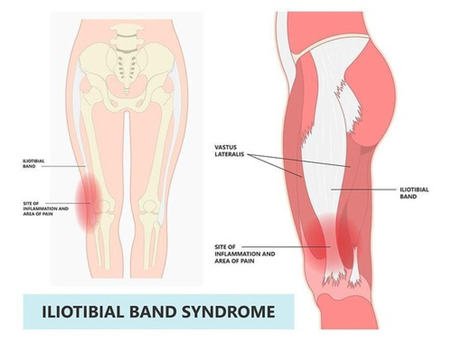<p>Pain caused by friction of the IT band.</p>