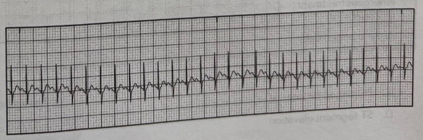 <p>Using the EKG tracing, identify the arrythmia that is present.</p><p>A. Sinus bradycardia</p><p>B. Sinus tachycardia</p><p>C. Junctional bradycardia</p><p>D. Junctional tachycardia</p>