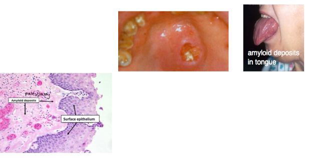 <p><span style="background-color: transparent; font-family: "Times New Roman", serif;"><u>SYSTEMIC</u>:</span></p><p><span style="background-color: transparent; font-family: "Times New Roman", serif;">*<strong>Most common: skeletal pain – due to bone lysis by accumulation of tumor cells </strong>→ multiple punched out radiolucencies with ill-defined margins/lack sclerotic border → pathological fractures</span></p><p><span style="background-color: transparent; font-family: "Times New Roman", serif;">*Renal failure</span></p><p><span style="background-color: transparent; font-family: "Times New Roman", serif;">*<strong>Severe bacterial infections</strong></span></p><p><span style="background-color: transparent; font-family: "Times New Roman", serif;">*<strong>Clotting defects → dental management considerations (bisphosphonate exposure?)</strong></span></p><p><span style="background-color: transparent; font-family: "Times New Roman", serif;">*Histology: sheets of plasma cells in various degrees of differentiation</span><br></p><p><span style="background-color: transparent; font-family: "Times New Roman", serif;"><u>ORAL</u>:</span></p><p><span style="background-color: transparent; font-family: "Times New Roman", serif;"><strong>*Jaw lesions → pain, swelling, numbness, tooth mobility</strong></span></p><p><span style="background-color: transparent; font-family: "Times New Roman", serif;"><strong>*Amyloid deposits throughout body: tongue, vestibule</strong></span></p>