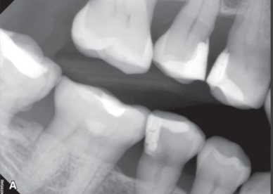 <p>What do bitewings serve as for periodontal disease?</p>