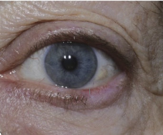 <p>The loss of lashes </p>