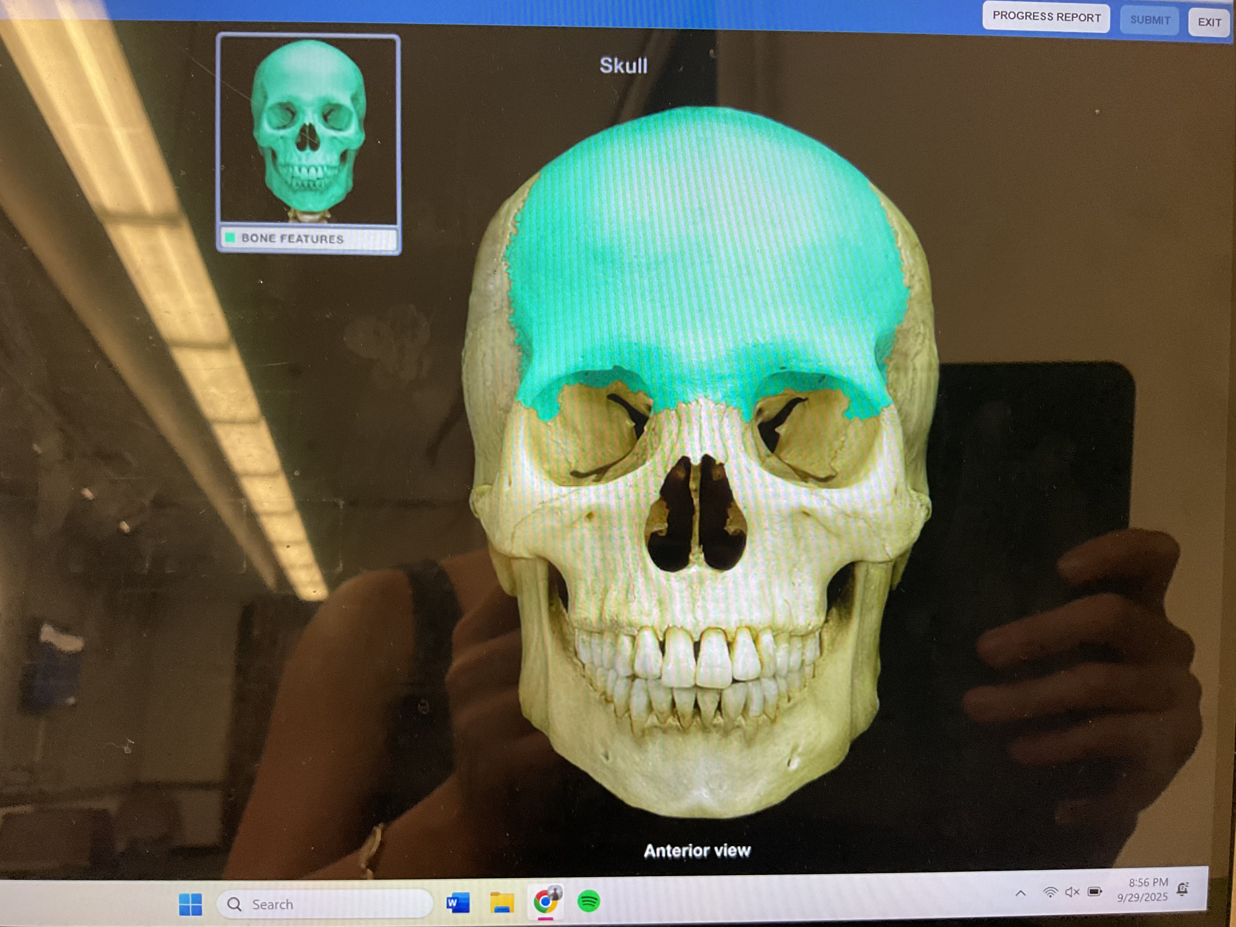 <p>Frontal bone </p>