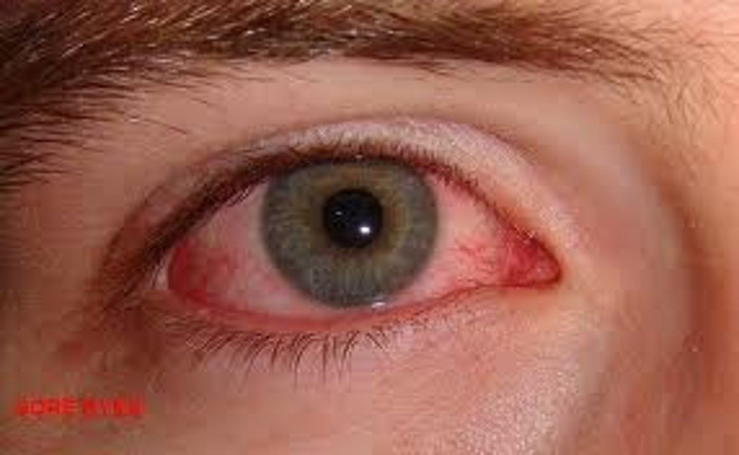 <p>eye inflammation</p>