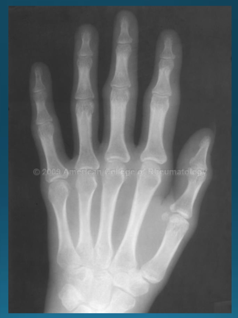 <p>what is the diagnosis and major finding? </p>