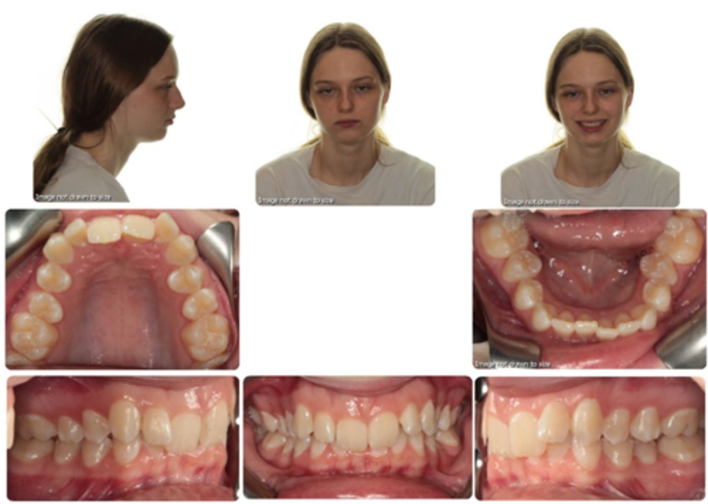 <p>What type of malocclusion does she have?</p>