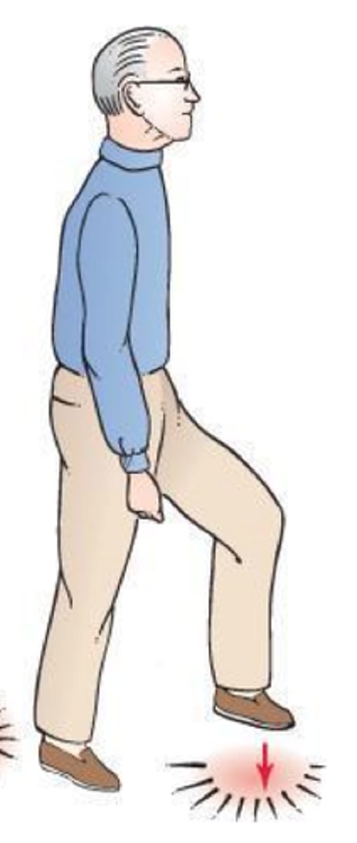 <p>type of unsteady walk, or sensory ataxia, caused by poor proprioception (sense of one's body in space)</p><p>- stomping, need to feel the ground because they dont know where it is</p>