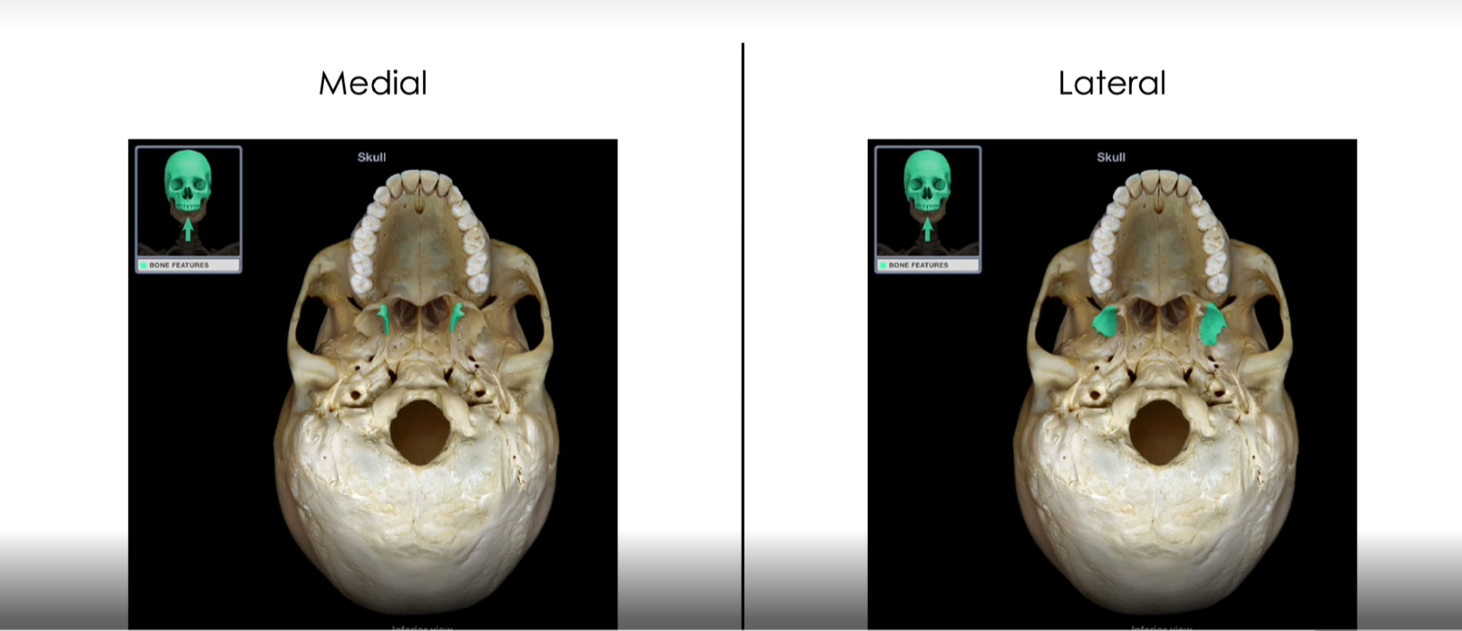 <p>Medial and Lateral Pterygoid Processes</p>