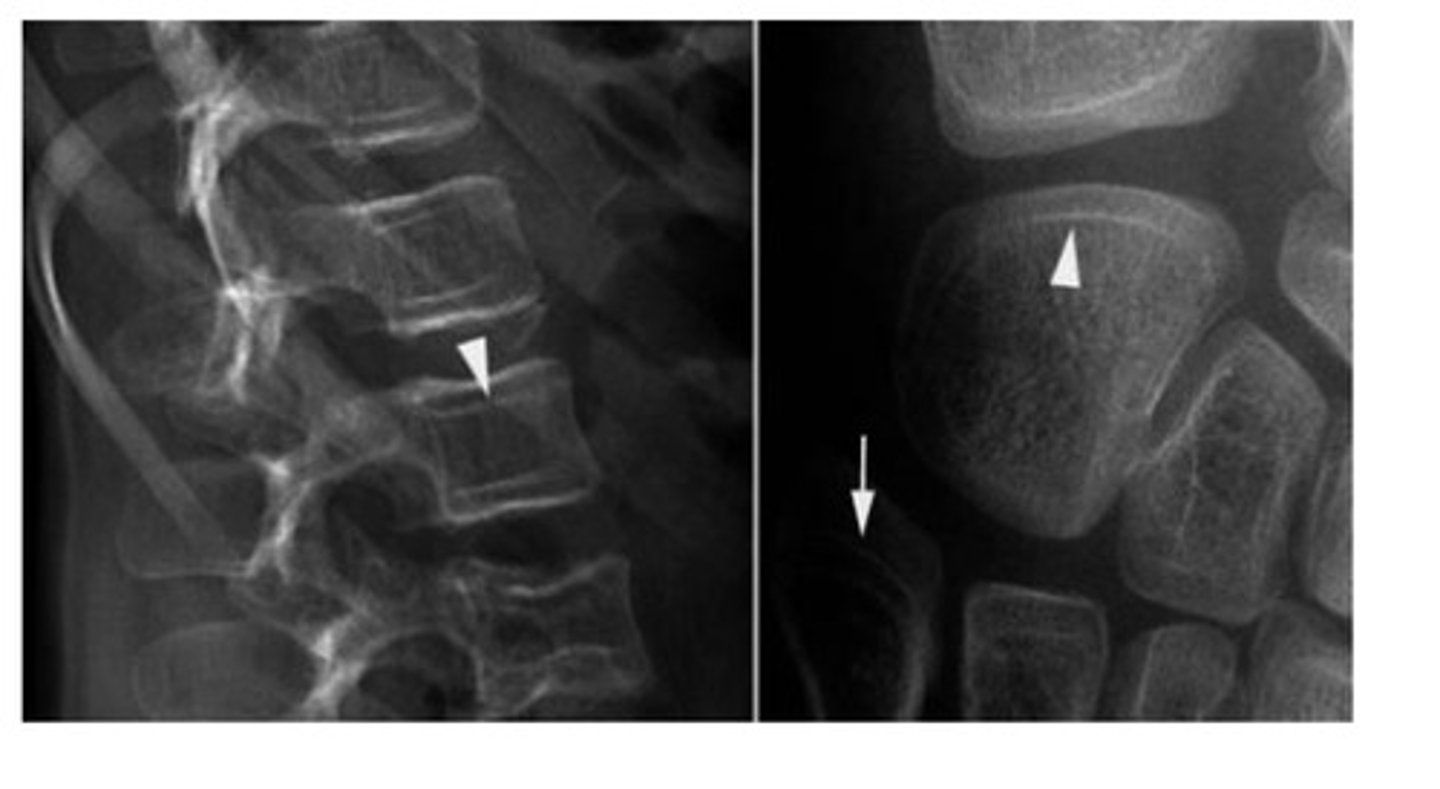 <p>Osteogenesis imperfecta</p>