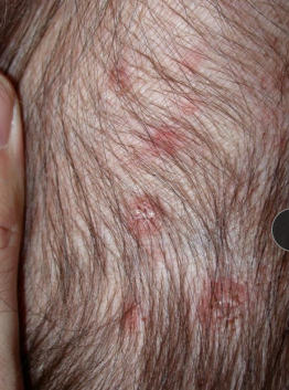 <p><span>Flat Primary Lesions</span></p>