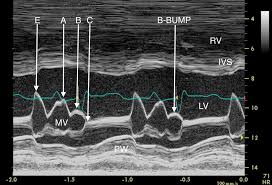<p>What does the b-bump represent on m-mode?</p><p>What condition is it seen in?</p>