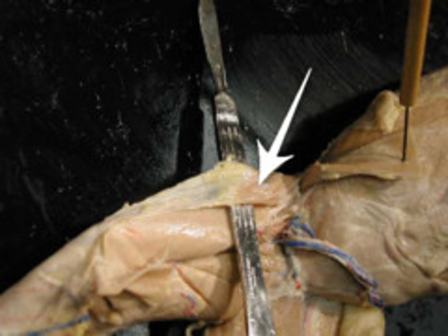 <p>What is this connective tissue, silver-whit tendon that connects with tensor fasciae latae?</p>