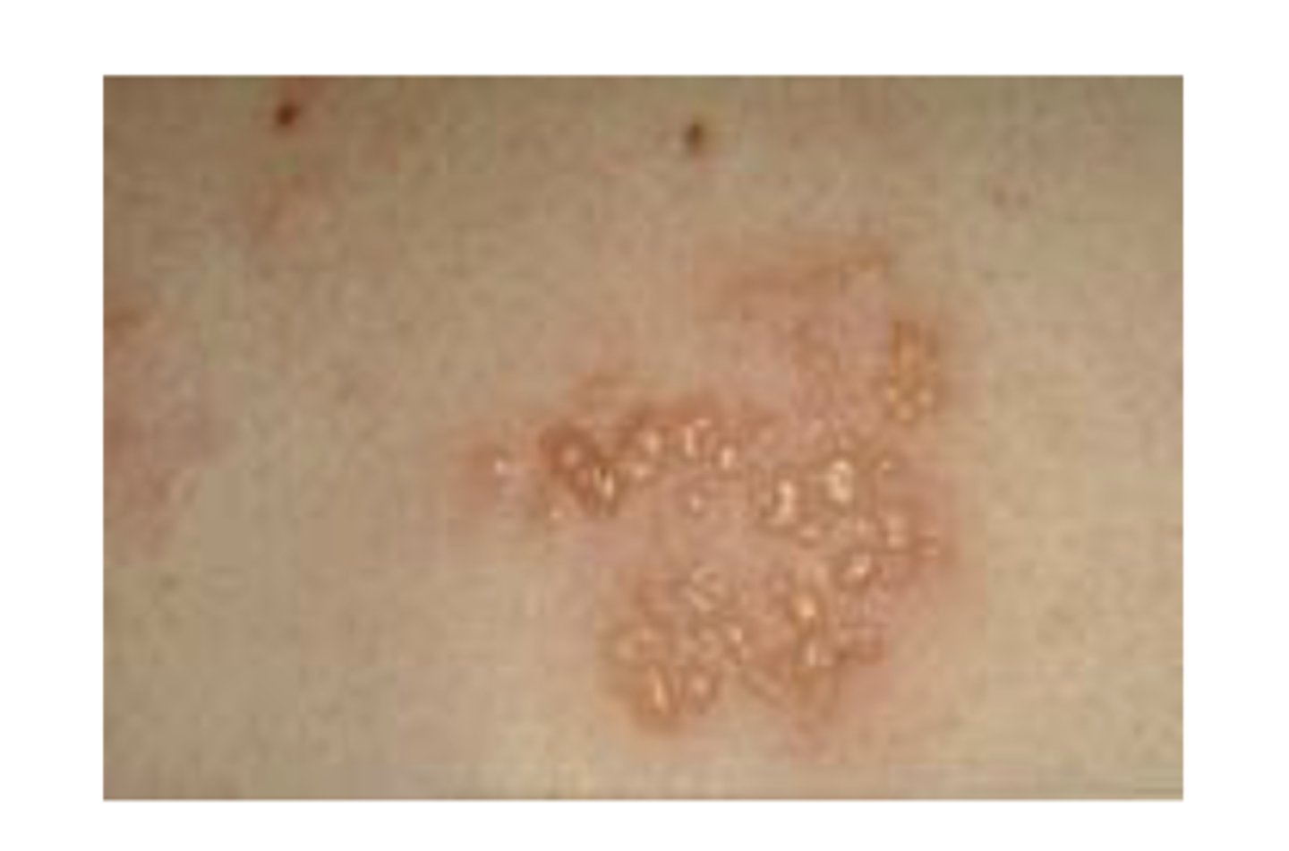 <p>A fluid filled, raised growth less than 1.0 cm in size</p>