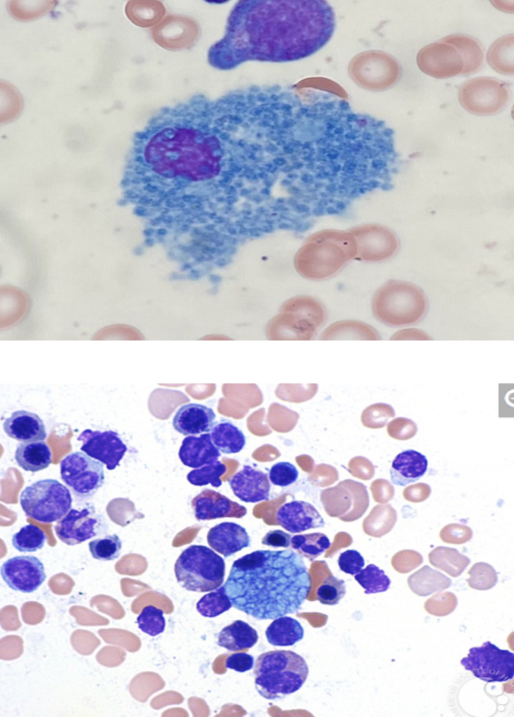 <p>Macrophage filled with ceroid (of its cytoplasm) that appears blue on Romanowsky-type stain</p>