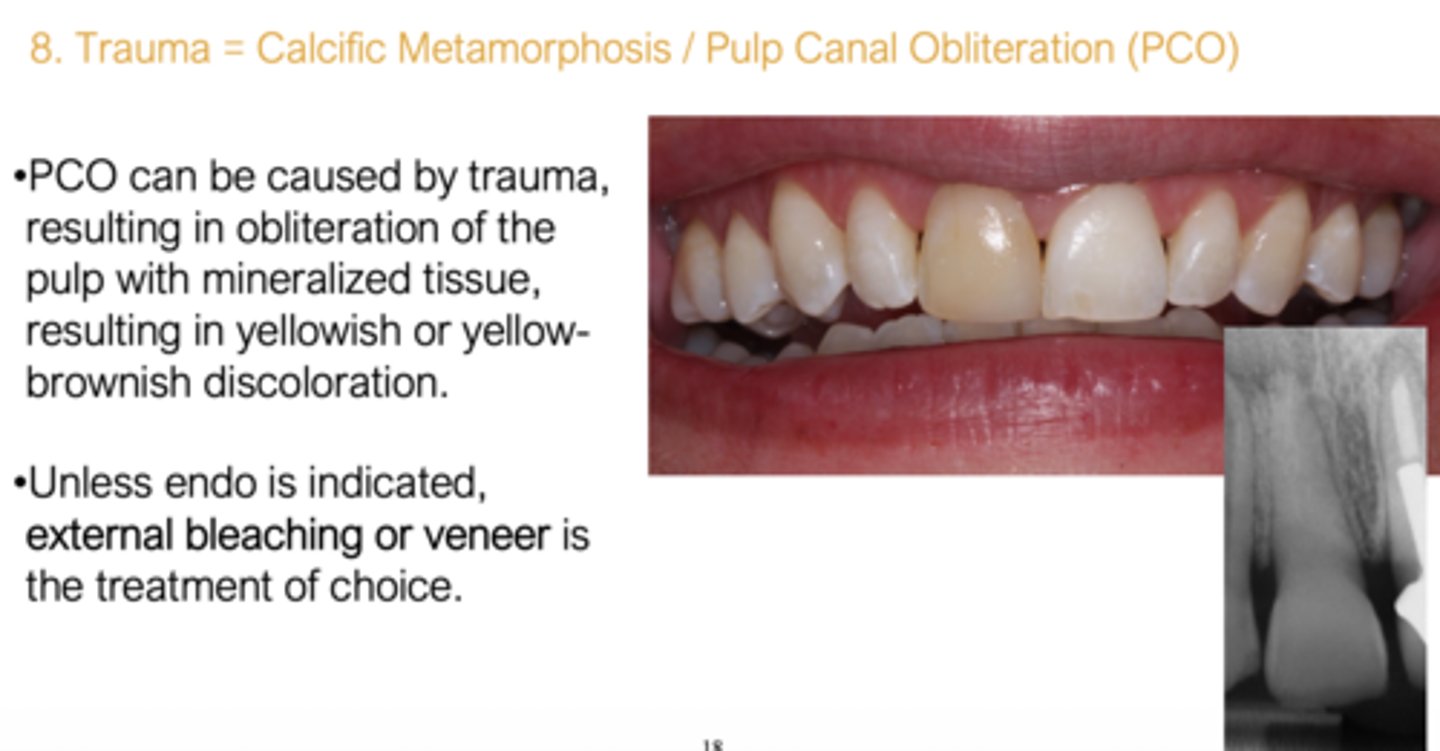<p>Calcific Metamorphosis/ Pulpal Canal Obliteration PCO/Trauma</p>