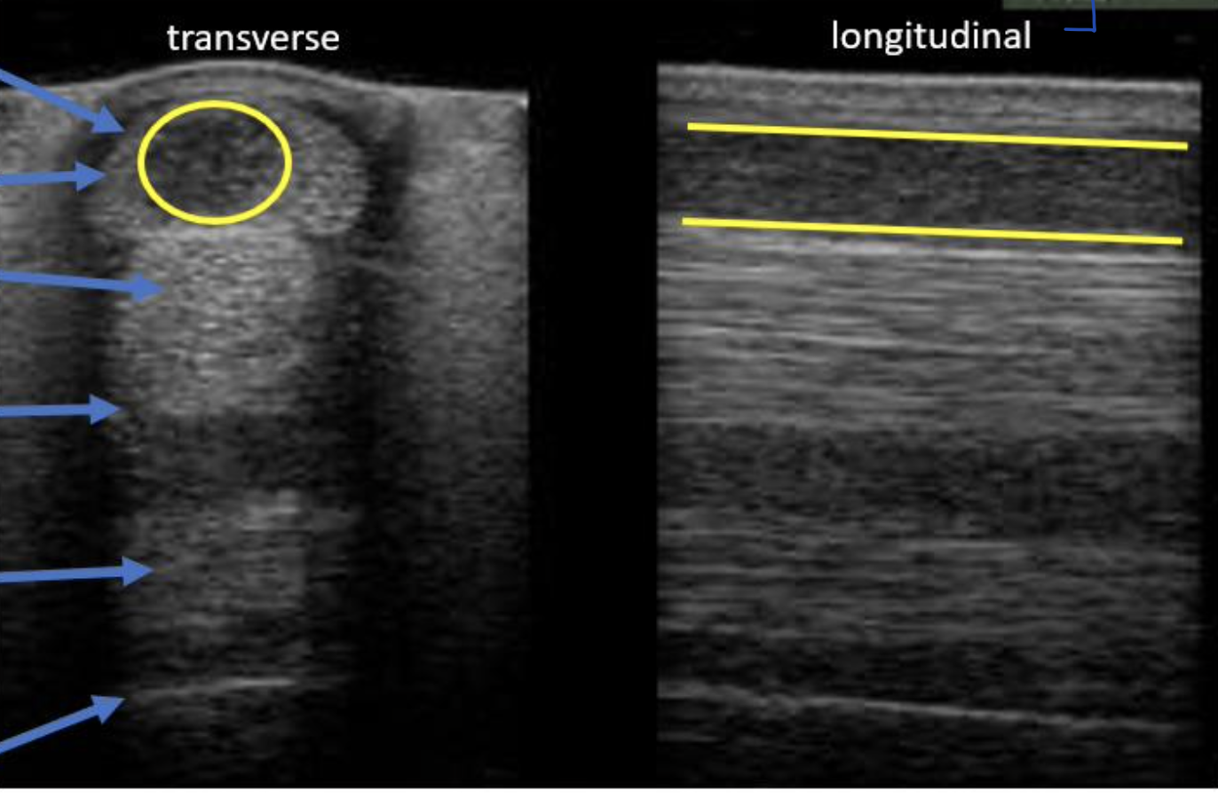 <p>Why does a "core lesion" on the SDF appear dark (hypoechoic to normal)? </p>
