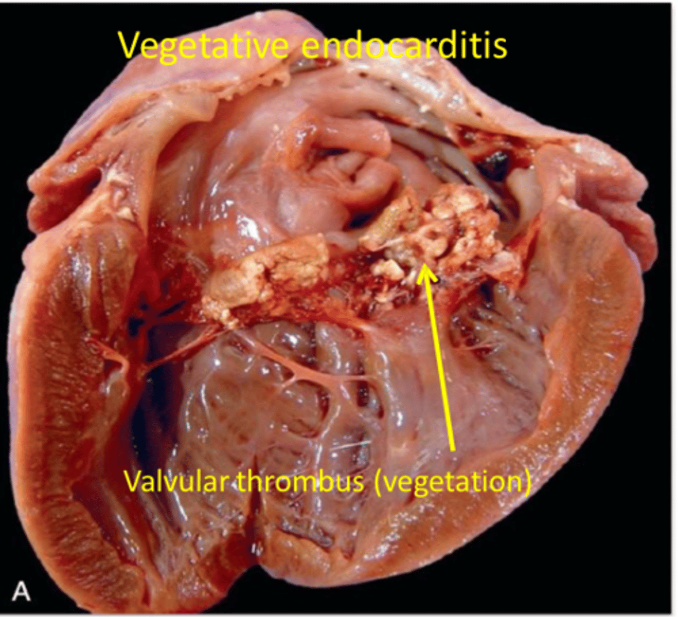 <p>Cardiac mural or valvular thrombi</p><p>Endarteritis (parasitic disease)</p><p>Neoplastic cell</p><p>Bacterial or septic</p>