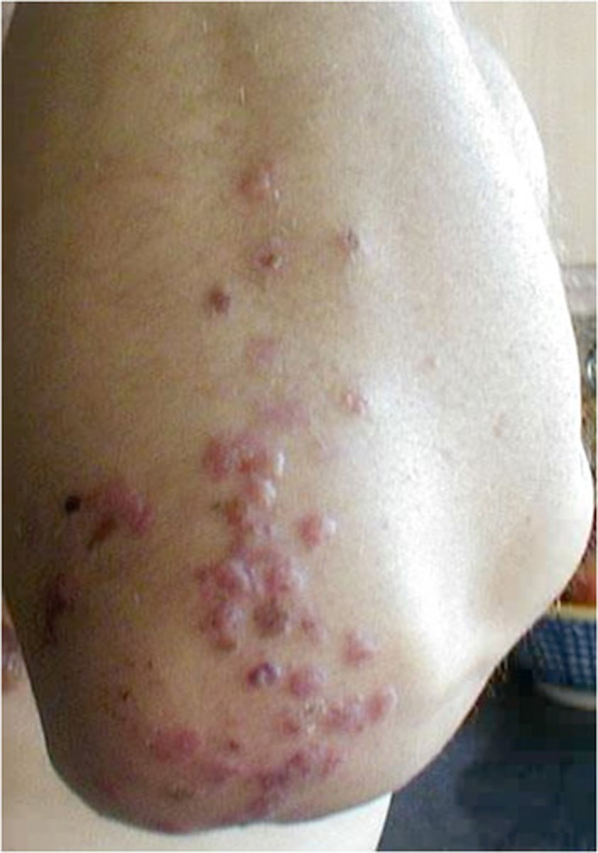 <p>Dermatitis Herpetiformis</p>