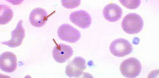 <ul><li><p>They are associated with regenerative anemias/splenectomy</p></li><li><p>Corticosteroid use</p></li><li><p>Chemotherapeutics</p></li></ul><p></p>